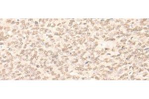 Immunohistochemistry of paraffin-embedded Human ovarian cancer tissue using RBM17 Polyclonal Antibody at dilution of 1:35(x200) (RBM17 anticorps)