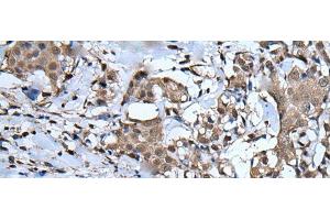 Immunohistochemistry of paraffin-embedded Human breast cancer tissue using UBA52 Polyclonal Antibody at dilution of 1:55(x200) (UBA52 anticorps)