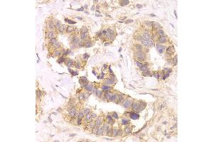 Immunohistochemistry of paraffin-embedded Human mammary cancer using CTNND1 antibody at dilution of 1:100 (x400 lens). (CTNND1 anticorps)