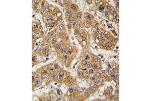 Formalin-fixed and paraffin-embedded human hepatocarcinoma tissue reacted with OE antibody (C-term) 7587b , which was peroxidase-conjugated to the secondary antibody, followed by DAB staining. (APOE anticorps  (C-Term))