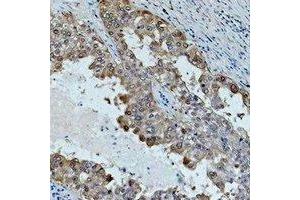 Immunohistochemical analysis of HSP70 staining in human lung cancer formalin fixed paraffin embedded tissue section. (HSP70 anticorps)