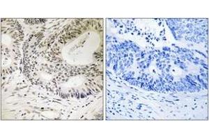 Immunohistochemistry analysis of paraffin-embedded human colon carcinoma, using 53BP1 (Phospho-Ser25) Antibody. (TP53BP1 anticorps  (pSer25))