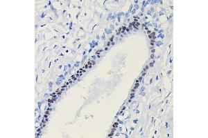 Immunohistochemistry of paraffin-embedded human breast cancer using Progesterone Receptor Rabbit pAb (ABIN6128570, ABIN6145518, ABIN6145519 and ABIN6213802) at dilution of 1:100 (40x lens).