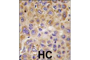 Formalin-fixed and paraffin-embedded human hepatocarcinoma tissue reacted with PFKFB1 antibody , which was peroxidase-conjugated to the secondary antibody, followed by DAB staining. (PFKFB1 anticorps  (AA 259-289))