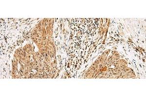 Immunohistochemistry of paraffin-embedded Human esophagus cancer tissue using GTF2H4 Polyclonal Antibody at dilution of 1:25(x200) (GTF2H4 anticorps)