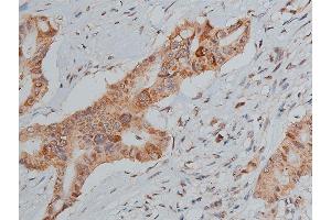 ABIN6267287 at 1/50 staining human lung cancer tissue sections by IHC-P.