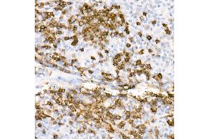 Immunohistochemistry of paraffin-embedded Human Hodgkin lymphoma using CD20 antibody (ABIN7268472) at dilution of 1:100 (40x lens). (CD20 anticorps)