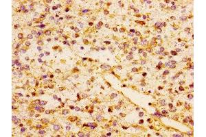 Immunohistochemistry of paraffin-embedded human glioma using ABIN7145966 at dilution of 1:100 (CCL17 anticorps  (AA 24-94))