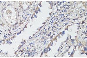 Immunohistochemistry of paraffin-embedded Human lung cancer using TrkB Polyclonal Antibody at dilution of 1:200 (40x lens). (TRKB anticorps)