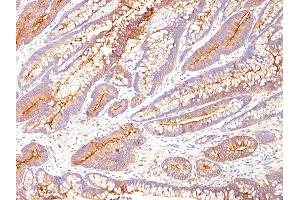 Formalin-fixed, paraffin-embedded human Colon Carcinoma stained with CEA Mouse Monoclonal Antibody (COL-1). (CEACAM5 anticorps)
