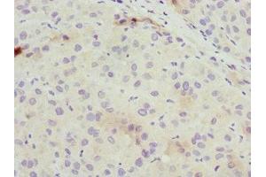 Immunohistochemistry of paraffin-embedded human liver cancer using ABIN7162309 at dilution of 1:100 (Osteocalcin anticorps  (AA 52-100))