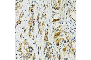 Immunohistochemistry of paraffin-embedded human colon carcinoma using TNNC1 antibody. (TNNC1 anticorps)