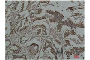 Immunohistochemistry (IHC) analysis of paraffin-embedded Human Breast Carcicnoma using HSP27 Mouse Monoclonal Antibody diluted at 1:200. (Cyclin B1 anticorps)