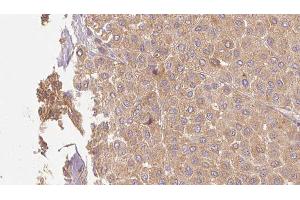 ABIN6273509 at 1/100 staining Human Melanoma tissue by IHC-P. (GZMM anticorps  (Internal Region))