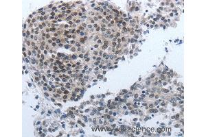 Immunohistochemistry of Human liver cancer using NPR1 Polyclonal Antibody at dilution of 1:40 (NPR1 anticorps)