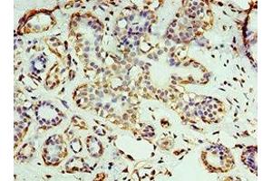 Immunohistochemistry of paraffin-embedded human breast cancer using ABIN7167670 at dilution of 1:100 (RNLS anticorps  (AA 18-342))