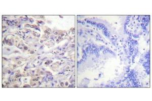 Immunohistochemical analysis of paraffin-embedded human lung carcinoma tissue using hnRPD (Phospho-Ser83) antibody (left)or the same antibody preincubated with blocking peptide (right). (HNRNPD/AUF1 anticorps  (pSer83))