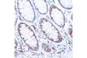 Immunohistochemistry of paraffin-embedded human colon carcinoma using NOMO1 Rabbit pAb (ABIN6128346, ABIN6144710, ABIN6144711 and ABIN6214793) at dilution of 1:350 (40x lens).