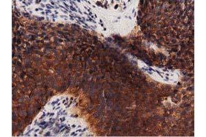 Immunohistochemical staining of paraffin-embedded Adenocarcinoma of Human endometrium tissue using anti-PRKD2 mouse monoclonal antibody.