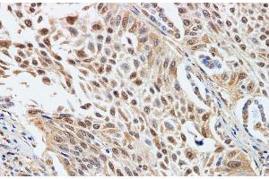 Immunohistochemistry of paraffin-embedded Human lung cancer using CDK4 Polyclonal Antibody at dilution of 1:200 (CDK4 anticorps)
