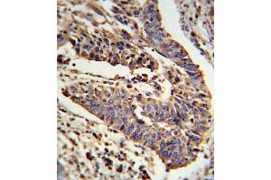 Formalin-fixed and paraffin-embedded human lung carcinoma reacted with SCNN1A Antibody (Center), which was peroxidase-conjugated to the secondary antibody, followed by DAB staining.