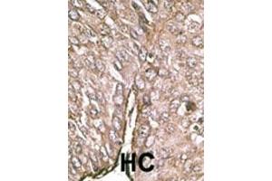 Formalin-fixed and paraffin-embedded human cancer tissue reacted with the primary antibody, which was peroxidase-conjugated to the secondary antibody, followed by DAB staining.