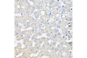 Immunohistochemistry of paraffin-embedded human liver injury using ARL6 antibody (ABIN5974886) at dilution of 1/100 (40x lens). (ARL6 anticorps)