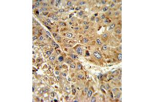 Formalin-fixed and paraffin-embedded human hepatocarcinoma reacted with GPX1 Antibody (C-term), which was peroxidase-conjugated to the secondary antibody, followed by DAB staining.