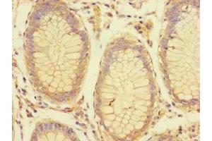 Immunohistochemistry of paraffin-embedded human colon cancer using ABIN7158198 at dilution of 1:100 (LRRC61 anticorps  (AA 1-259))