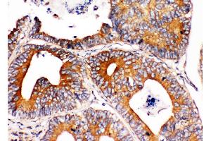 Anti-Integrin alpha 1 antibody,  IHC(P) IHC(P): Human Intestinal Cancer Tissue (Integrin alpha 1 anticorps  (C-Term))