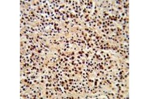 IHC analysis of FFPE human lymphoma stained with LCK antibody