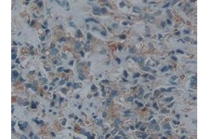 IHC-P analysis of Human Prostate cancer Tissue, with DAB staining. (ECE1 anticorps  (AA 469-721))
