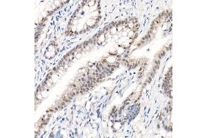 Immunohistochemistry of paraffin-embedded human colon carcinoma using Phospho--S473 Rabbit pAb (ABIN1513328, ABIN5664973, ABIN5664975 and ABIN6225474) at dilution of 1:50 (40x lens). (AKT1 anticorps  (pSer473))