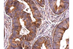 IHC-P Image Survivin antibody detects Survivin protein at cytosol on human colon carcinoma by immunohistochemical analysis. (Survivin anticorps)