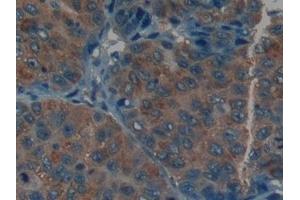 Detection of CK9 in Human Liver cancer Tissue using Polyclonal Antibody to Cytokeratin 9 (CK9)