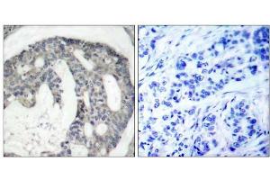 Immunohistochemical analysis of paraffin-embedded human breast carcinoma tissue using eNOS (phospho-Ser1176) antibody (E011156). (ENOS anticorps  (pSer1176))