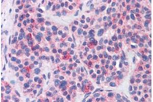 Anti-MBOAT4 antibody  ABIN1102980 IHC staining of human thyroid, medullary carcinoma. (MBOAT4 anticorps  (Internal Region))