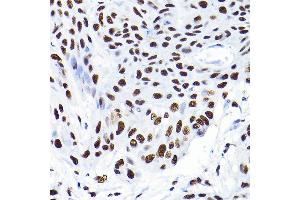 Immunohistochemistry of paraffin-embedded human esophageal cancer using K/K/TRIM28 Rabbit pAb  at dilution of 1:200 (40x lens). (KAP1 anticorps  (AA 576-835))