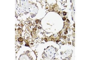 Immunohistochemistry of paraffin-embedded human lung cancer using IL6R Rabbit pAb (ABIN3015521, ABIN3015522, ABIN3015523, ABIN1680455 and ABIN6218635) at dilution of 1:50 (40x lens). (IL-6 Receptor anticorps  (AA 20-320))