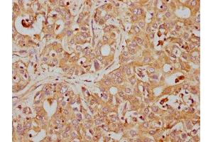 IHC image of ABIN7127407 diluted at 1:155 and staining in paraffin-embedded human liver cancer performed on a Leica BondTM system. (Recombinant CD63 anticorps)