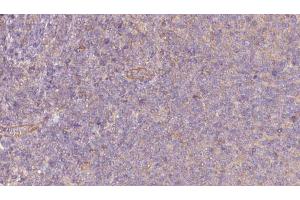 ABIN6273065 at 1/100 staining Human lymph cancer tissue by IHC-P.