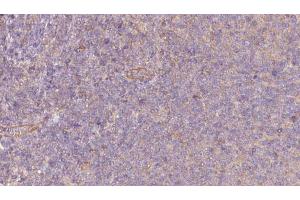 ABIN6273065 at 1/100 staining Human lymph cancer tissue by IHC-P. (PKLR anticorps  (Internal Region))
