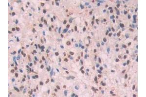 Detection of Ab1-42 in Human Glioma Tissue using Monoclonal Antibody to Amyloid Beta Peptide 1-42 (Ab1-42)