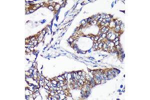 Immunohistochemistry of paraffin-embedded Human colon carcinoma using  Rabbit pAb (ABIN7265696) at dilution of 1:100 (40x lens).