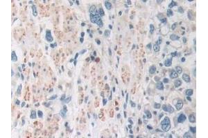 Detection of SIRT4 in Human Stomach cancer Tissue using Polyclonal Antibody to Sirtuin 4 (SIRT4)