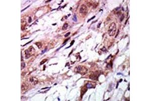 IHC analysis of FFPE human breast carcinoma tissue stained with the AURKC antibody
