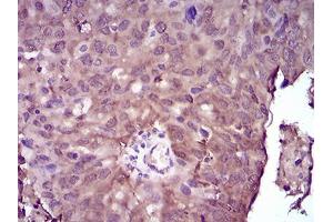 Immunohistochemical analysis of paraffin-embedded ovarian cancer tissues using NME2 mouse mAb with DAB staining.