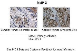Application: IHC Species+tissue/cell type: Control-Human small intestine, Sample-human colorectal cancer Primary antibody dilution: 1:100 Secondary antibody: Biotinylated pig anti-rabbit+streptavidin-HRP (MMP3 anticorps  (Middle Region))