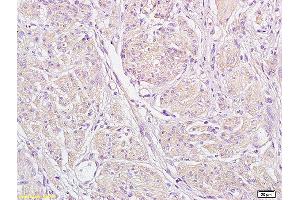 Formalin-fixed and paraffin embedded human endometrial carcinoma labeled with Anti-STIM1 Polyclonal Antibody, Unconjugated (ABIN1387605) at 1:200 followed by conjugation to the secondary antibody and DAB staining (STIM1 anticorps  (AA 85-180))