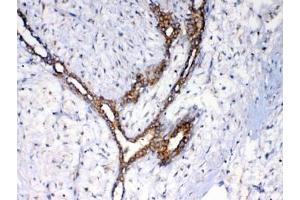 IHC testing of FFPE human breast cancer tissue with NSF antibody at 1ug/ml. (NSF anticorps)